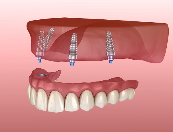 Replace Multiple Missing Teeth With All On  ®