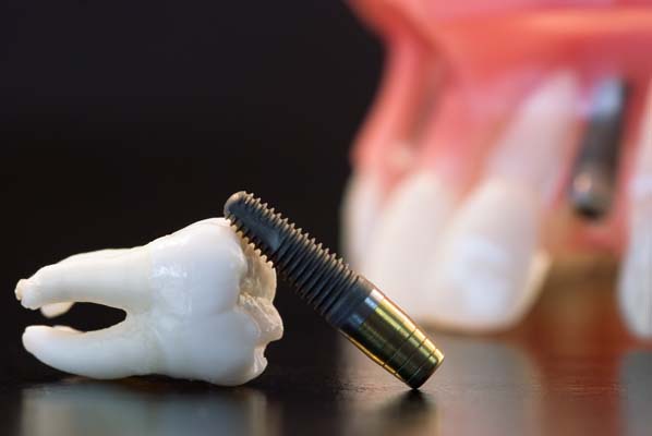 Dental Implants Restorations Troy, OH